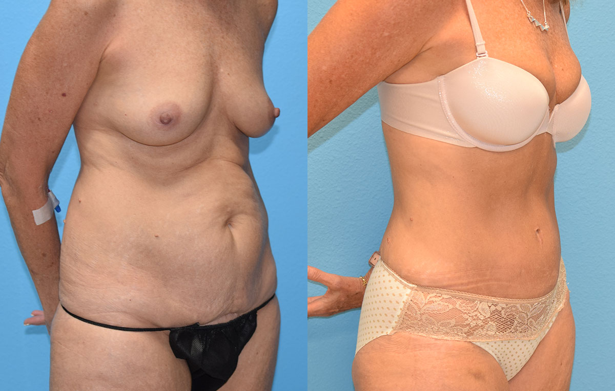 Tummy Tuck results by Dr. Maningas at Maningas Cosmetic Surgery in Missouri and Arkansas