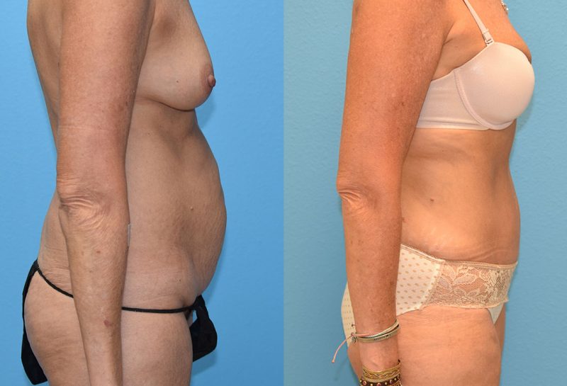 Tummy Tuck results by Dr. Maningas at Maningas Cosmetic Surgery in Missouri and Arkansas