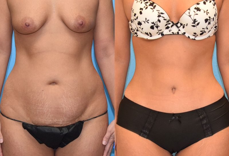 Tummy Tuck results by Dr. Maningas at Maningas Cosmetic Surgery in Missouri and Arkansas