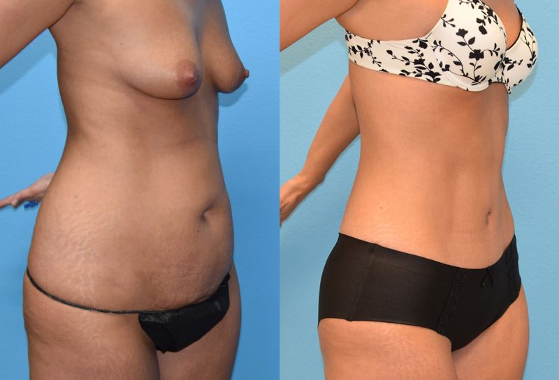 Tummy Tuck results by Dr. Maningas at Maningas Cosmetic Surgery in Missouri and Arkansas