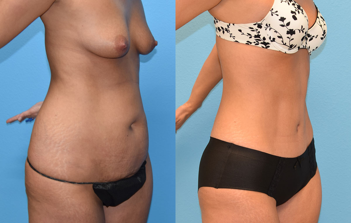 Tummy Tuck results by Dr. Maningas at Maningas Cosmetic Surgery in Missouri and Arkansas