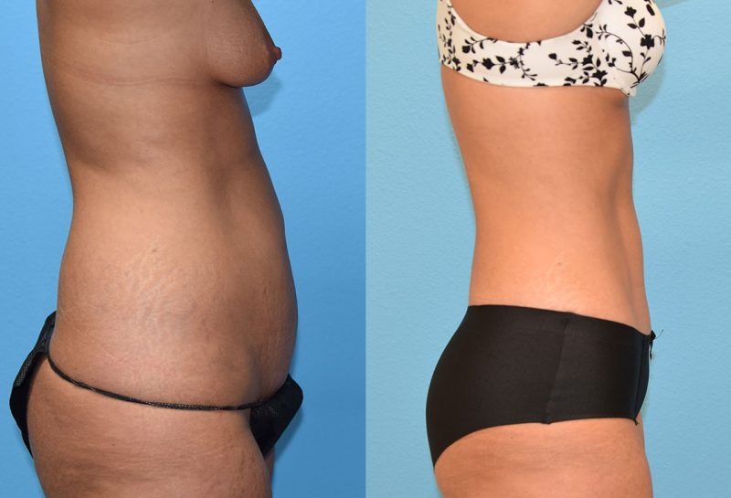 Tummy Tuck results by Dr. Maningas at Maningas Cosmetic Surgery in Missouri and Arkansas