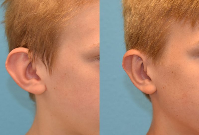 Otoplasty, or ear surgery, results by Dr. Maningas at Maningas Cosmetic Surgery in Joplin, MO