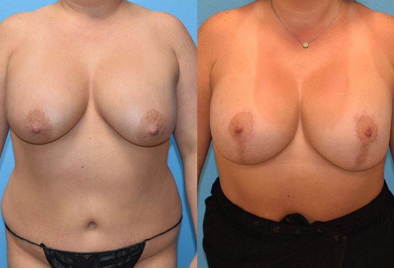 Breast lift with implants surgery by Dr. Maningas at Maningas Cosmetic Surgery in Joplin, MO