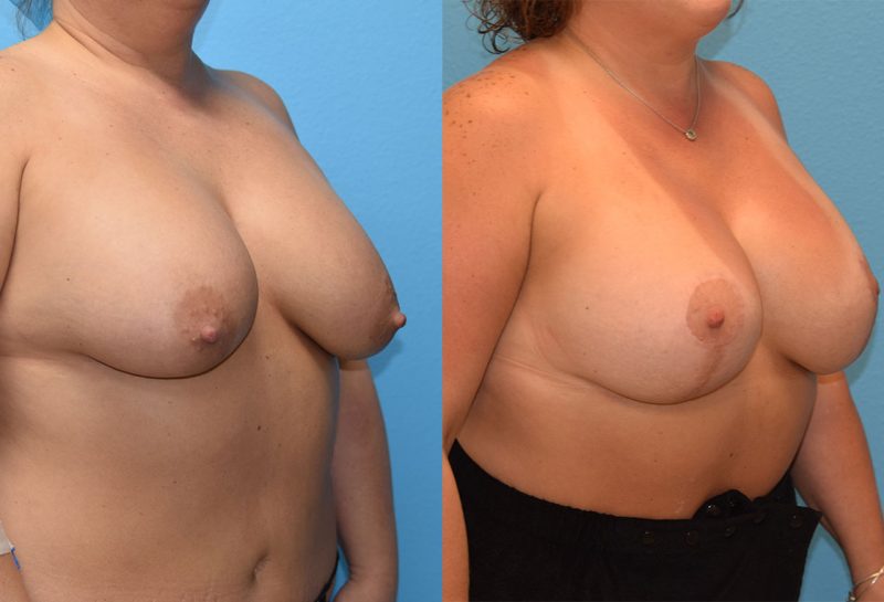 Breast lift with implants surgery by Dr. Maningas at Maningas Cosmetic Surgery in Joplin, MO