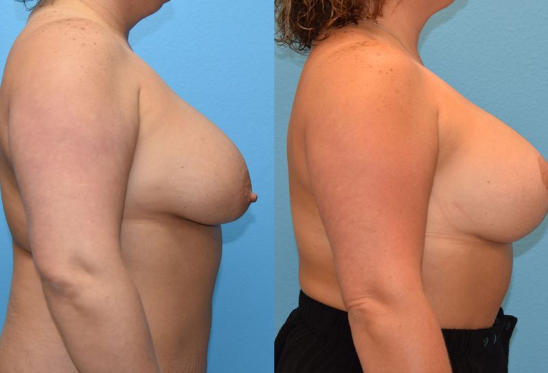 Breast lift with implants surgery by Dr. Maningas at Maningas Cosmetic Surgery in Joplin, MO