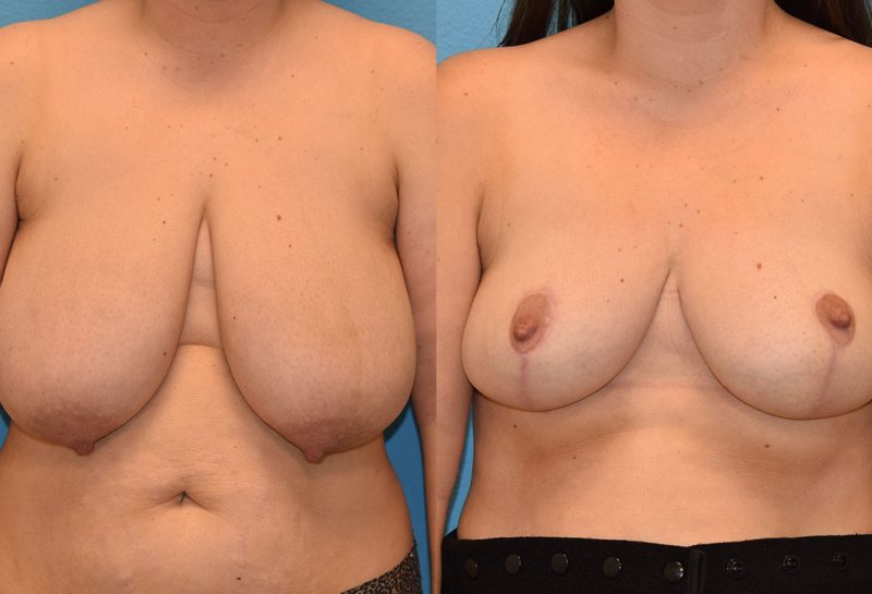 breast reduction results by Dr. Maningas as Maningas Cosmetic Surgery