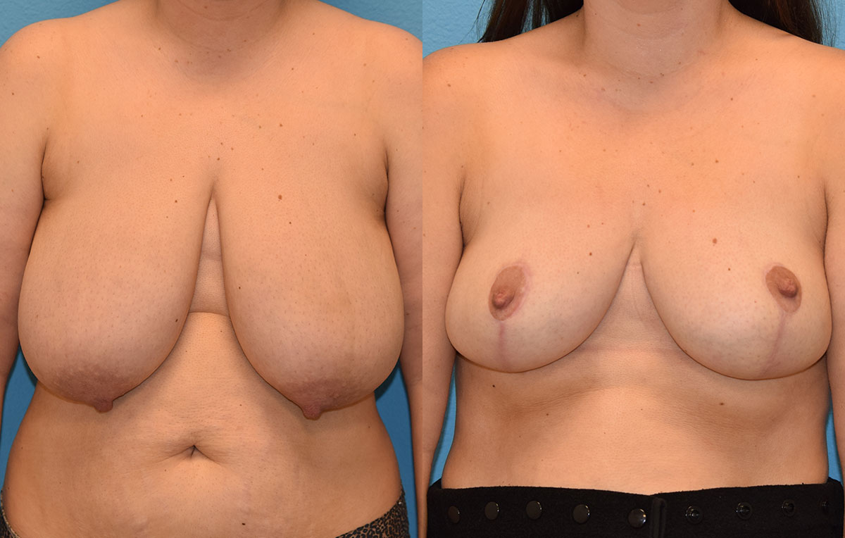 breast reduction results by Dr. Maningas as Maningas Cosmetic Surgery