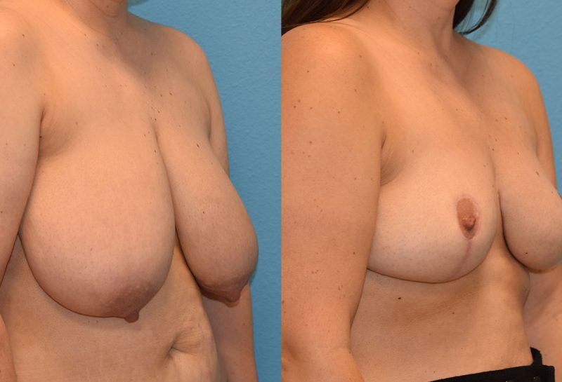 breast reduction results by Dr. Maningas as Maningas Cosmetic Surgery