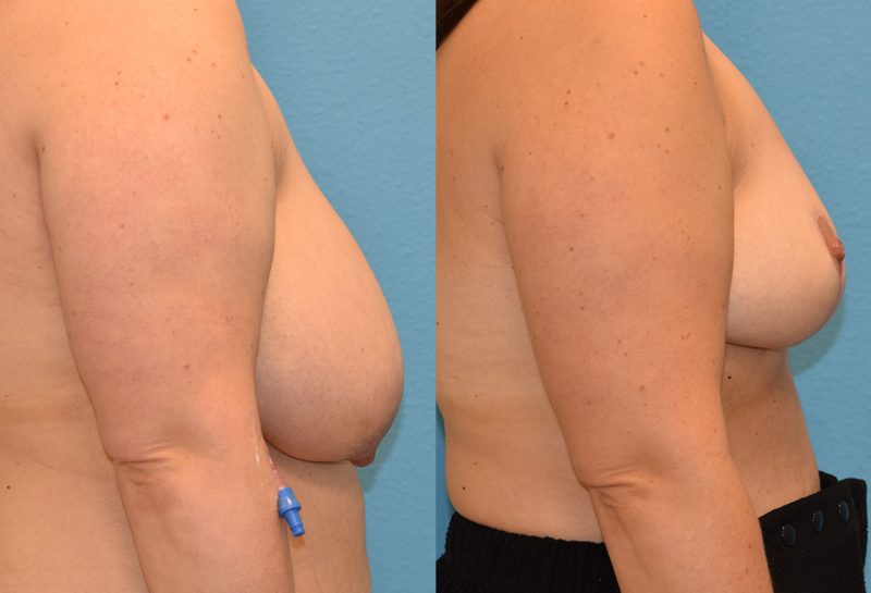 breast reduction results by Dr. Maningas as Maningas Cosmetic Surgery