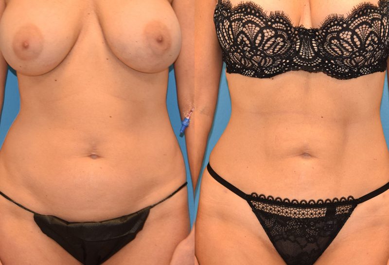 Skin Tightening and Liposuction results at Maningas Cosmetic Surgery in Joplin, MO