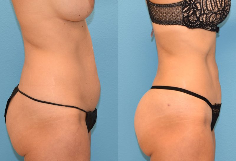 Skin Tightening and Liposuction results at Maningas Cosmetic Surgery in Joplin, MO