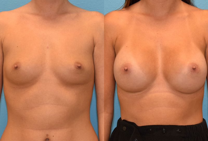 Breast augmentation results by dr. maningas at maningas cosmetic surgery in joplin, mo