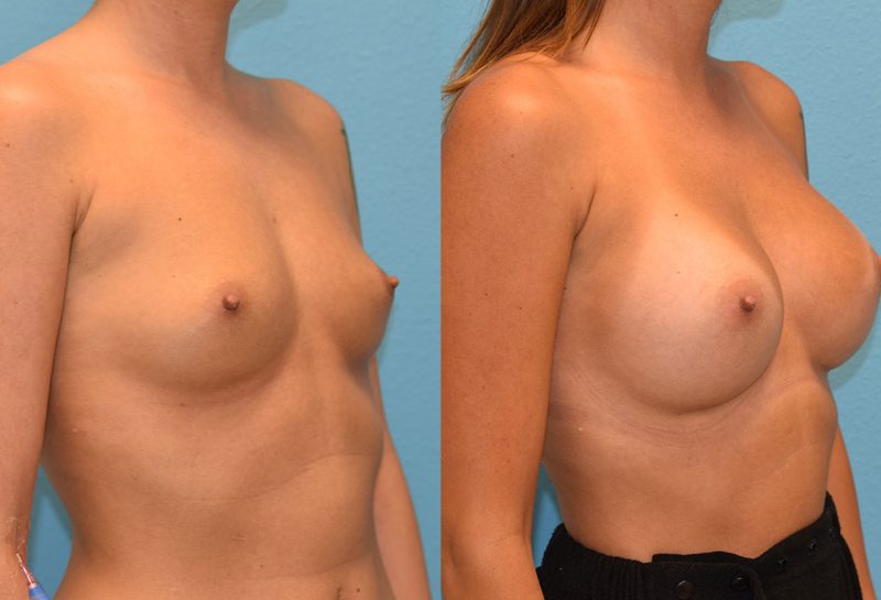 Breast augmentation results by dr. maningas at maningas cosmetic surgery in joplin, mo