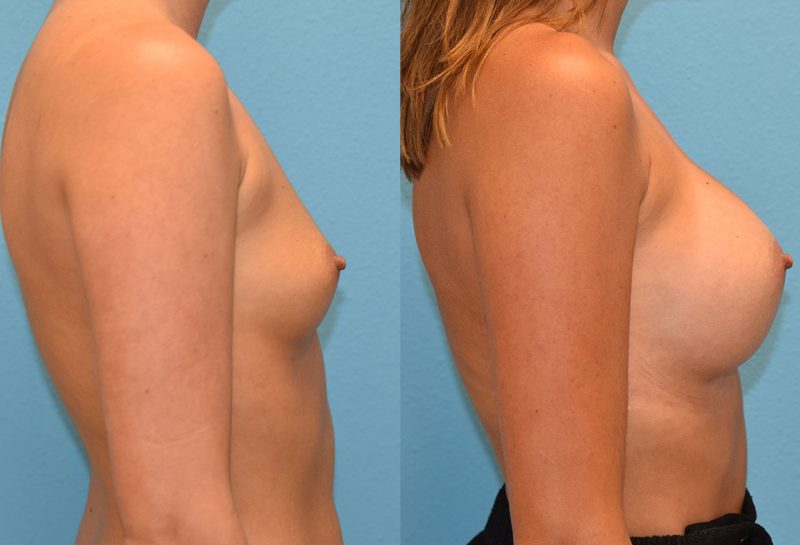 Breast augmentation results by dr. maningas at maningas cosmetic surgery in joplin, mo