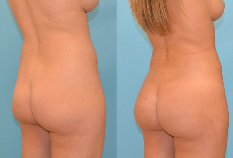 Brazilian Butt Lift by Dr. Maningas at Maningas Cosmetic Surgery in Joplin, MO