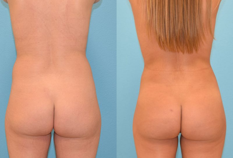 Brazilian Butt Lift by Dr. Maningas at Maningas Cosmetic Surgery in Joplin, MO