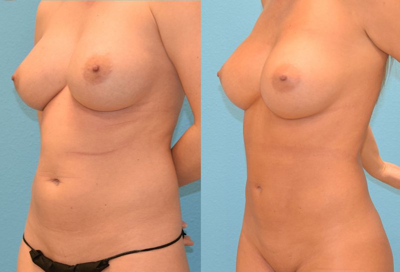 Liposuction Results by Dr. Maningas at Maningas Cosmetic Surgery in Joplin, MO