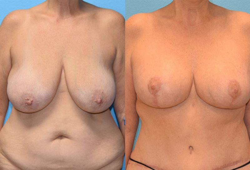 Breast lift with implants surgery by Dr. Maningas at Maningas Cosmetic Surgery in Joplin, MO