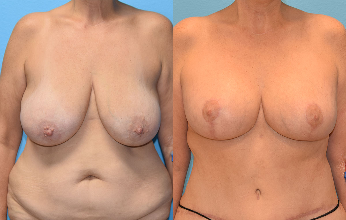 Breast lift with implants surgery by Dr. Maningas at Maningas Cosmetic Surgery in Joplin, MO