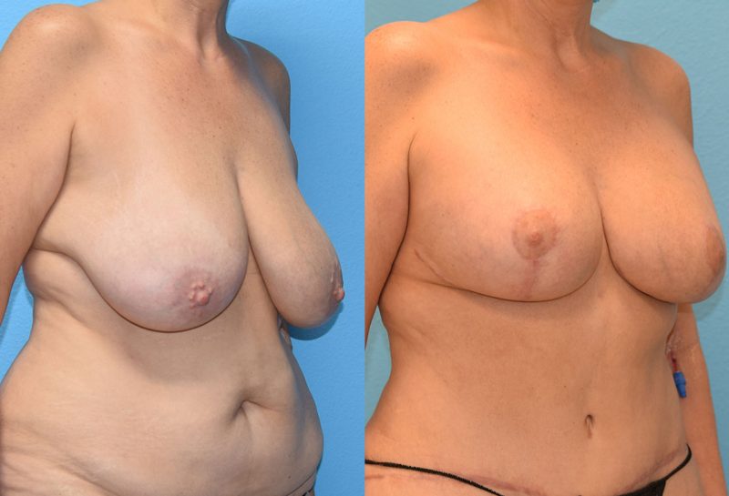 Breast lift with implants surgery by Dr. Maningas at Maningas Cosmetic Surgery in Joplin, MO