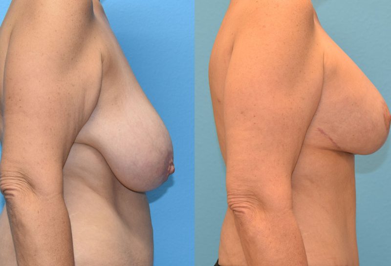 Breast lift with implants surgery by Dr. Maningas at Maningas Cosmetic Surgery in Joplin, MO