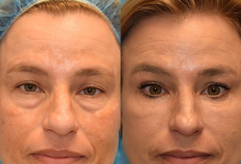 Eyelid Lift and CO2 Laser Resurfacing results at Maningas Cosmetic Surgery in Joplin, MO and Northwest Arkansas