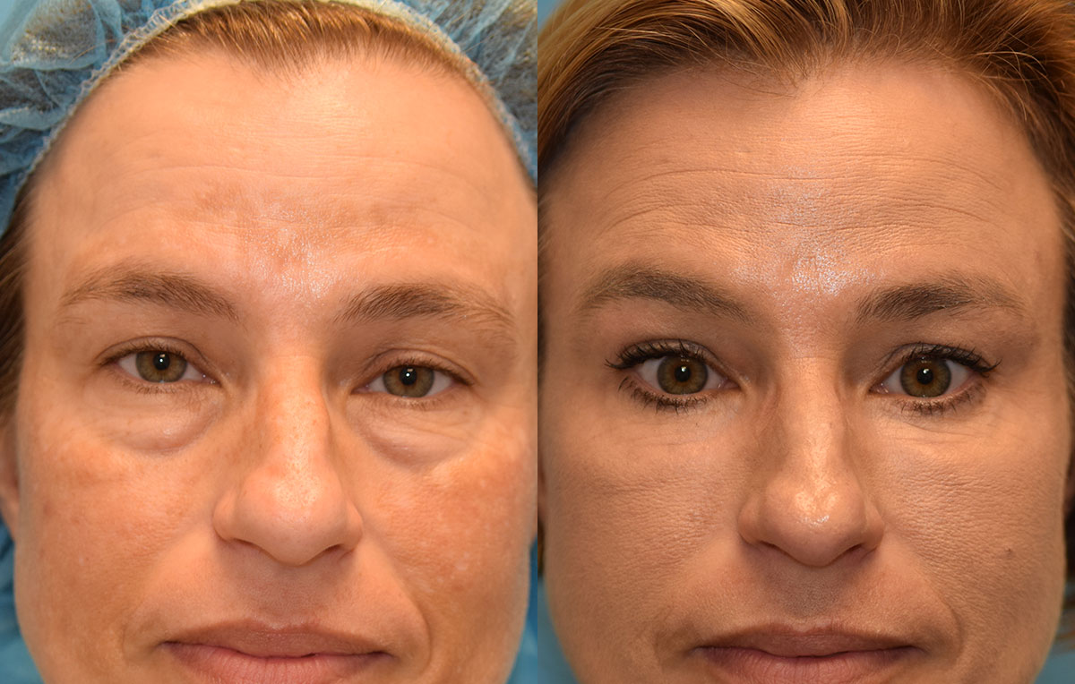 Eyelid Lift and CO2 Laser Resurfacing results at Maningas Cosmetic Surgery in Joplin, MO and Northwest Arkansas