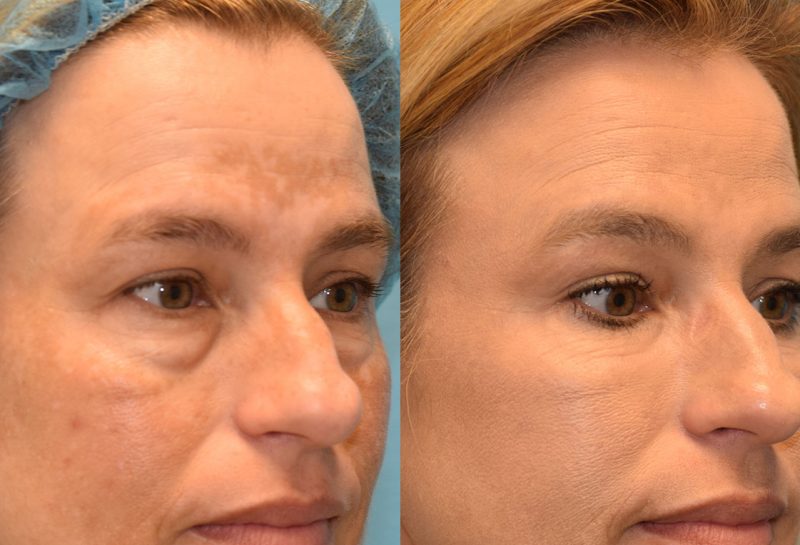 Eyelid and Brow Lift surgery results at Maningas Cosmetic Surgery in Joplin, MO and Northwest Arkansas