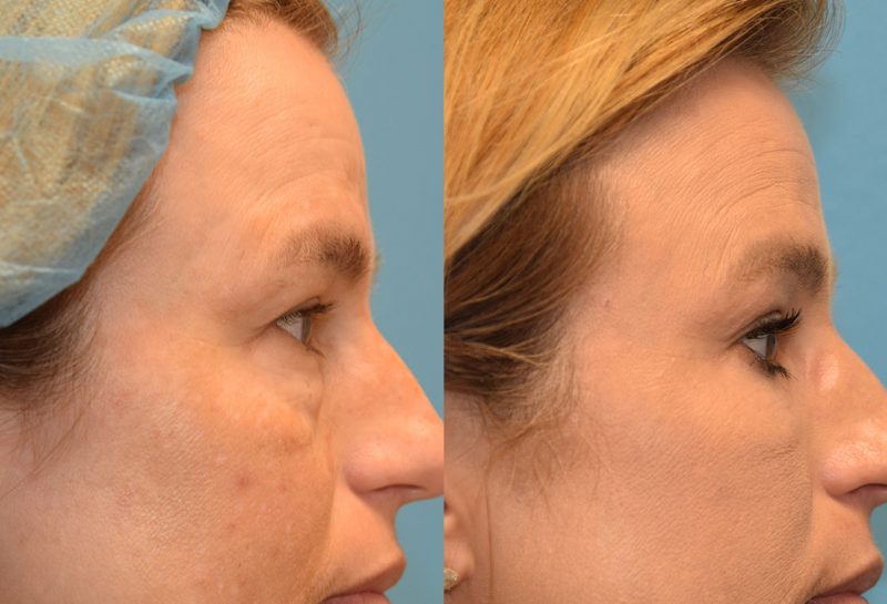 Eyelid and Brow Lift surgery results at Maningas Cosmetic Surgery in Joplin, MO and Northwest Arkansas