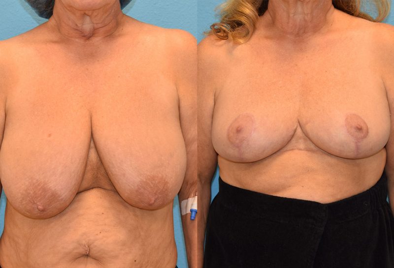 breast reduction results by Dr. Maningas as Maningas Cosmetic Surgery