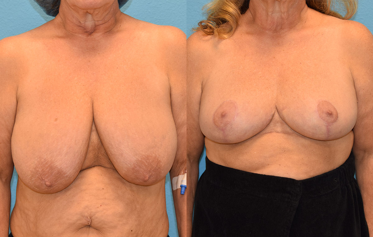 breast reduction results by Dr. Maningas as Maningas Cosmetic Surgery