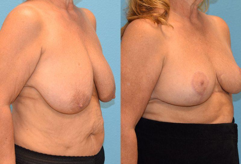 breast reduction results by Dr. Maningas as Maningas Cosmetic Surgery