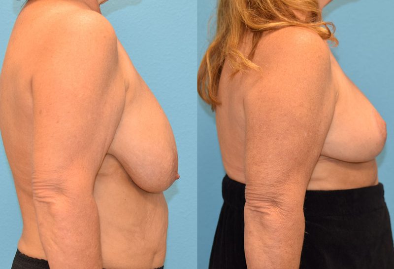 breast reduction results by Dr. Maningas as Maningas Cosmetic Surgery