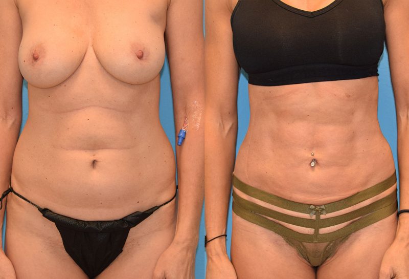 Skin Tightening with BodyTite and Liposuction results at Maningas Cosmetic Surgery in Joplin, MO