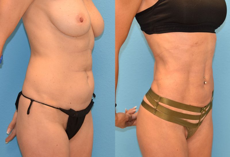 Skin Tightening with BodyTite and Liposuction results at Maningas Cosmetic Surgery in Joplin, MO