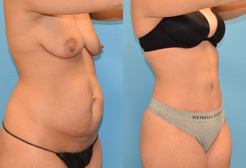 Tummy Tuck results by Dr. Maningas at Maningas Cosmetic Surgery in Missouri and Arkansas