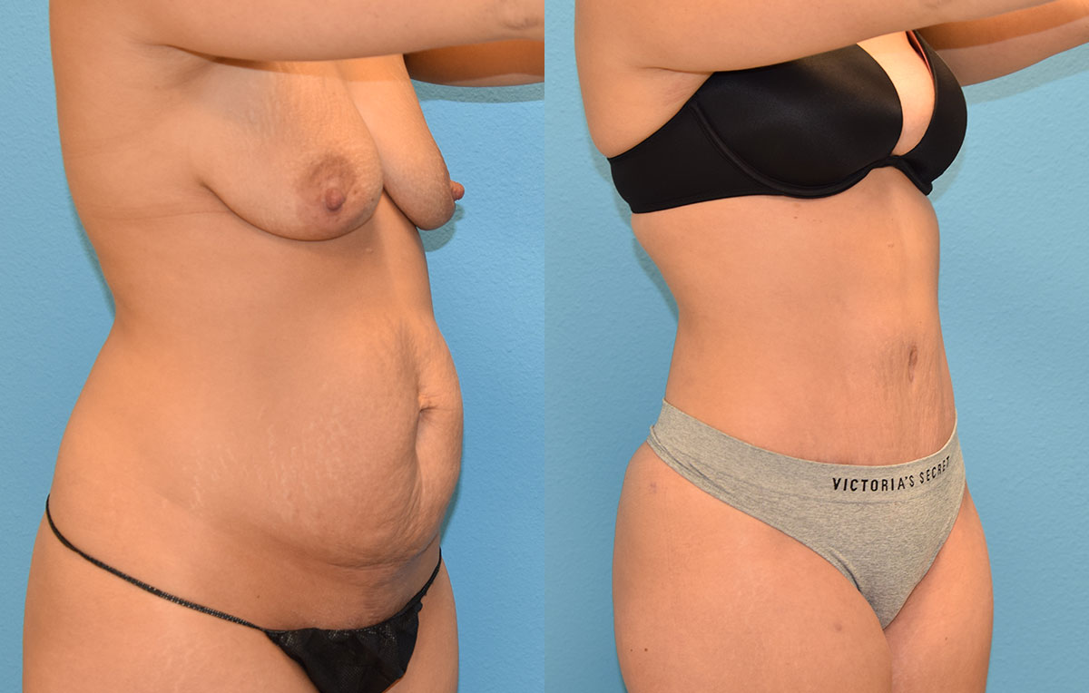 Tummy Tuck results by Dr. Maningas at Maningas Cosmetic Surgery in Missouri and Arkansas