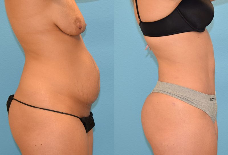 Tummy Tuck results by Dr. Maningas at Maningas Cosmetic Surgery in Missouri and Arkansas