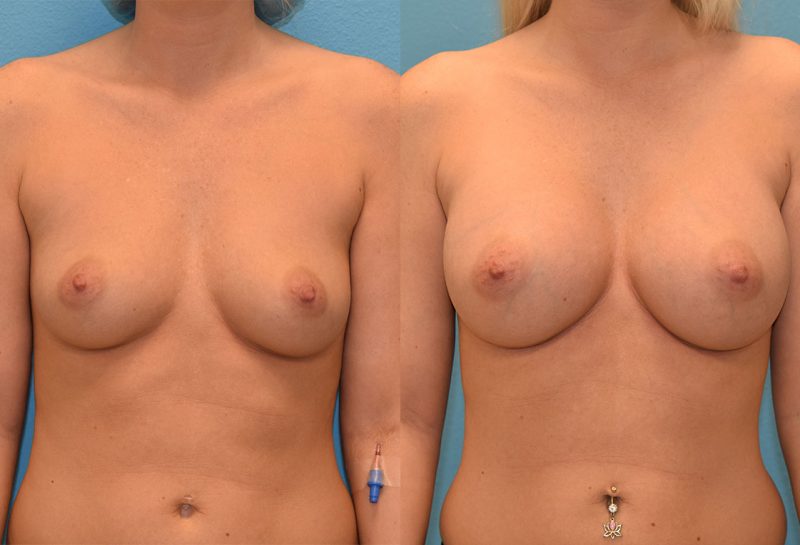 breast augmentation results by dr. maningas at maningas cosmetic surgery in joplin, mo