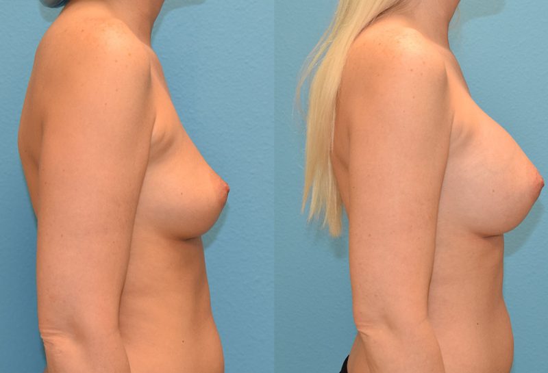 breast augmentation results by dr. maningas at maningas cosmetic surgery in joplin, mo