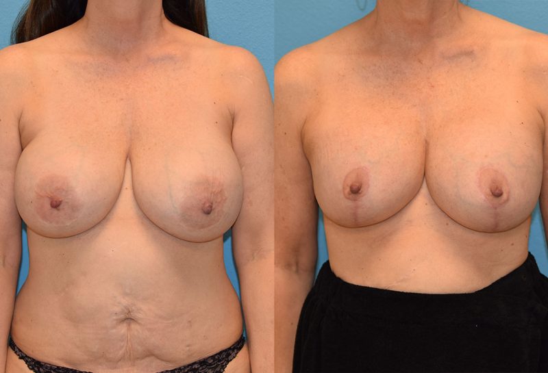 Breast Lift with Implants results by Dr. Maningas as Maningas Cosmetic Surgery