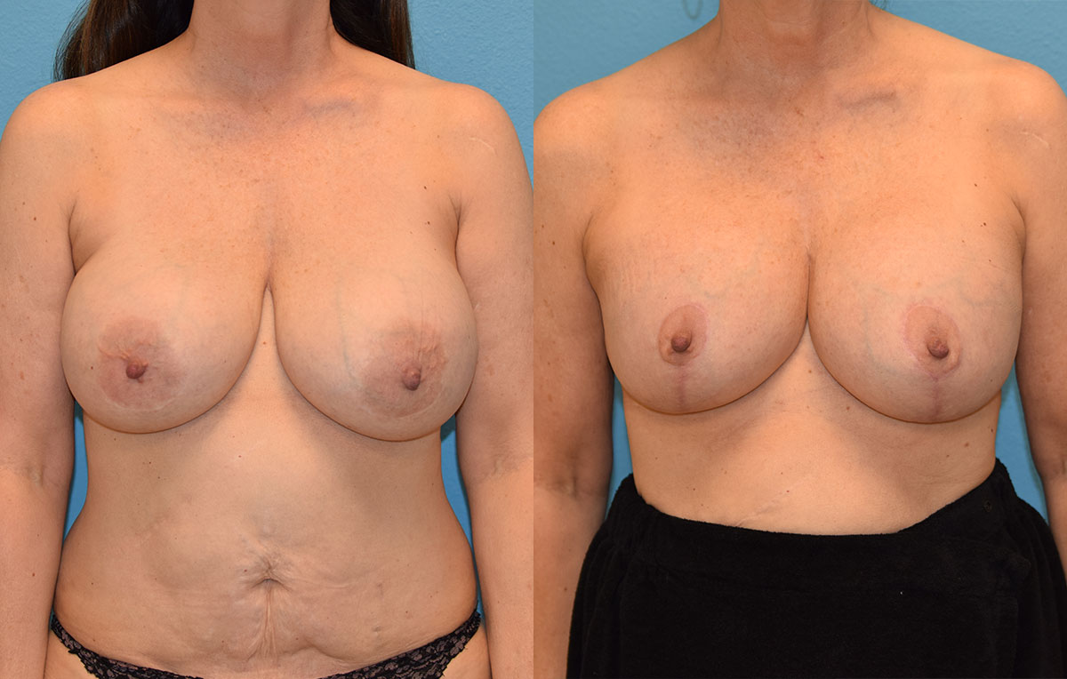 Breast Lift with Implants results by Dr. Maningas as Maningas Cosmetic Surgery