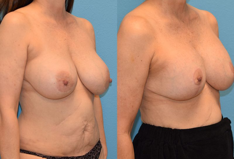 Breast Lift with Implants results by Dr. Maningas as Maningas Cosmetic Surgery