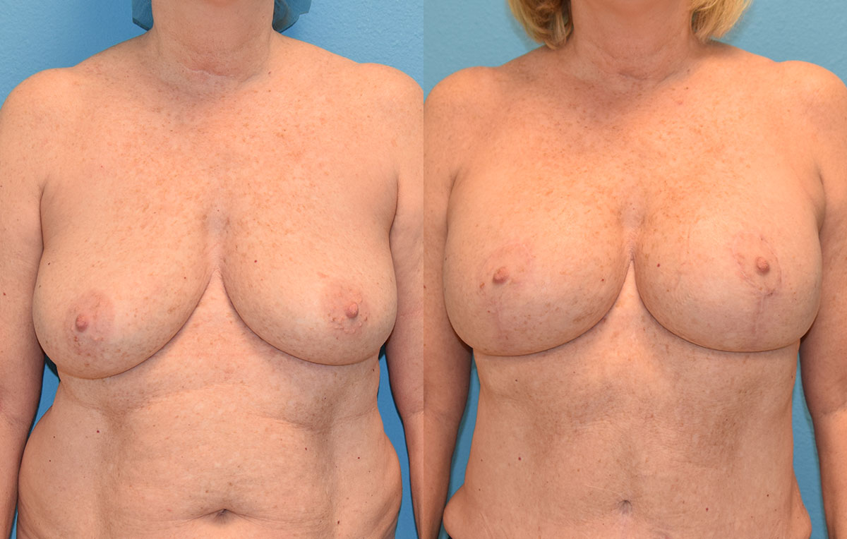 Breast Lift with Implants results by Dr. Maningas as Maningas Cosmetic Surgery