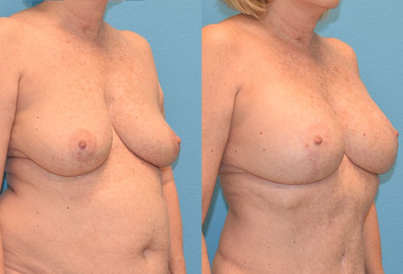 Breast Lift with Implants results by Dr. Maningas as Maningas Cosmetic Surgery