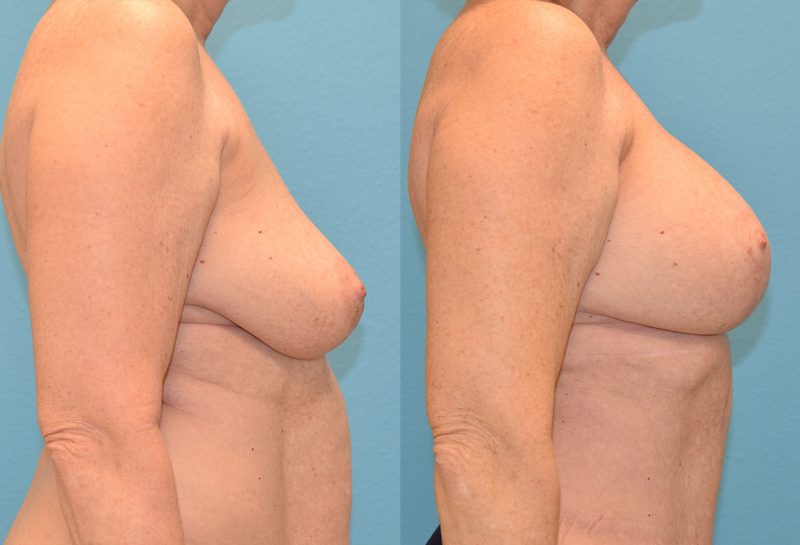 Breast Lift with Implants results by Dr. Maningas as Maningas Cosmetic Surgery