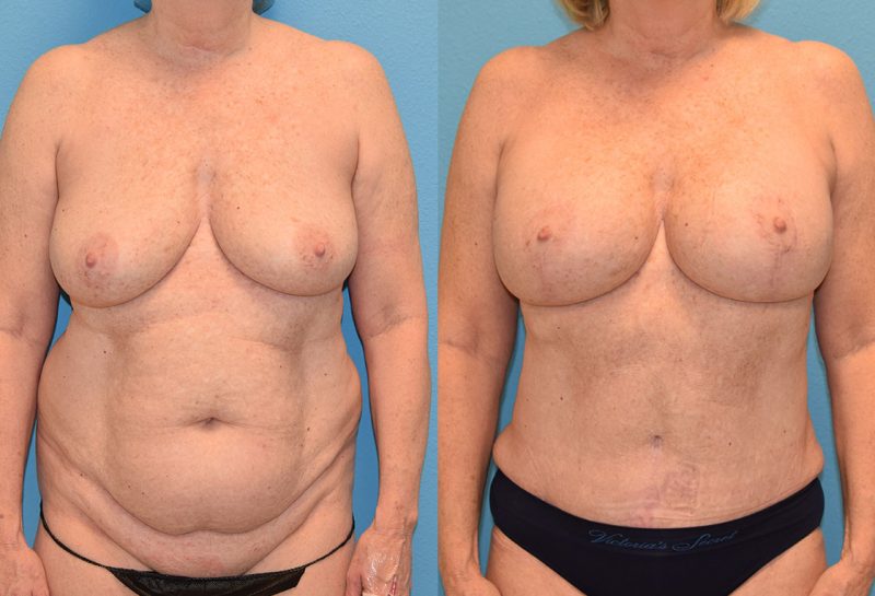 Mommy Makeover results by Dr. Maningas at Maningas Cosmetic Surgery in Joplin, MO