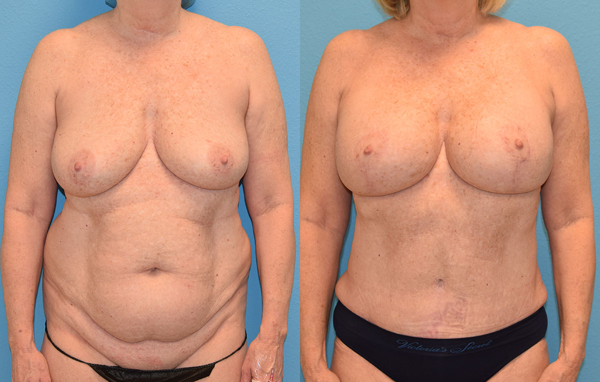 Mommy Makeover results by Dr. Maningas at Maningas Cosmetic Surgery in Joplin, MO