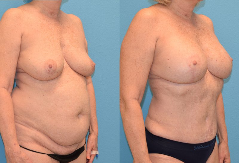 Mommy Makeover results by Dr. Maningas at Maningas Cosmetic Surgery in Joplin, MO